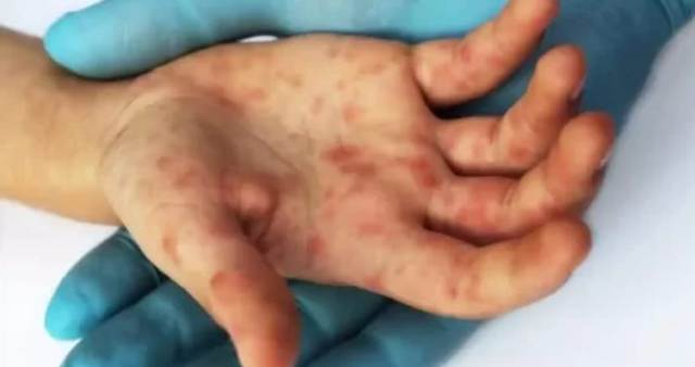 Viruela del mono: Con un caso sospechoso en la Argentina, ¿Cuáles son los síntomas?