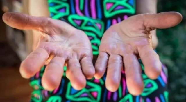 El tamaño de tus dedos podría determinar la gravedad del Covid si te contagiás