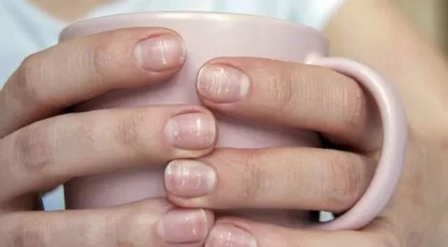 ¿Cómo están tus uñas? Chequeá estas 6 señales de alerta para descartar enfermedades mortales