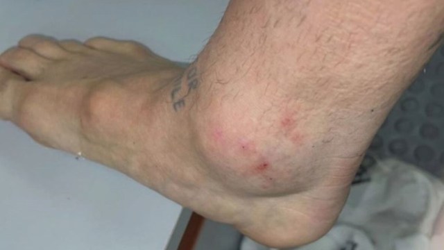 Impactante: Así quedó el tobillo del «Papu» Gómez tras el duelo con Chile