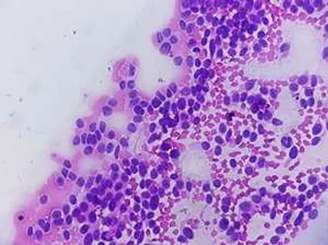 Alertan sobre el linfoma de células del manto, un cáncer poco frecuente y de difícil diagnóstico